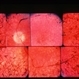 Retinitis Pigmentosa